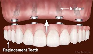 maxillary denture-implants