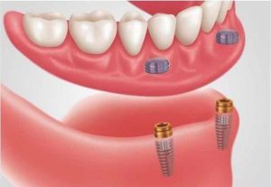 snap on lower denture