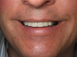 Dental Proceedures make you look younger - After Dental Proceedures make you look younger - After photo of Sugar Land Dentist, Stuar Rimes, dental procedure