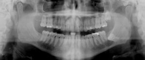 Dental X-Rays